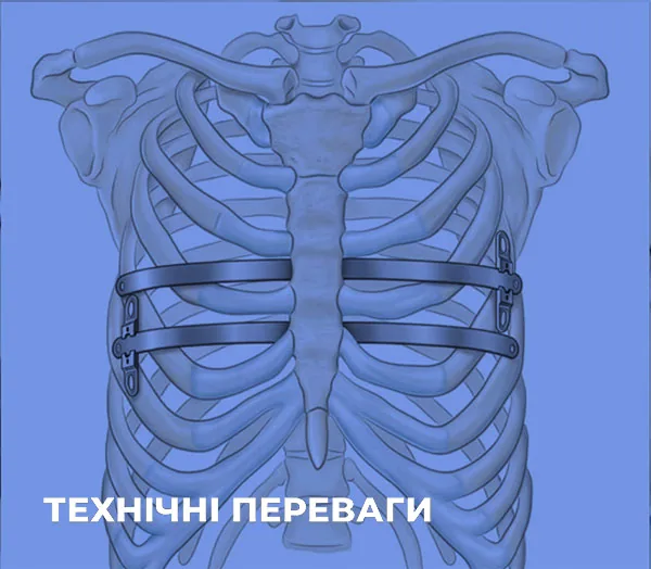 Схема грудної клітки з двома фіксаторами, встановленими за методом Насса