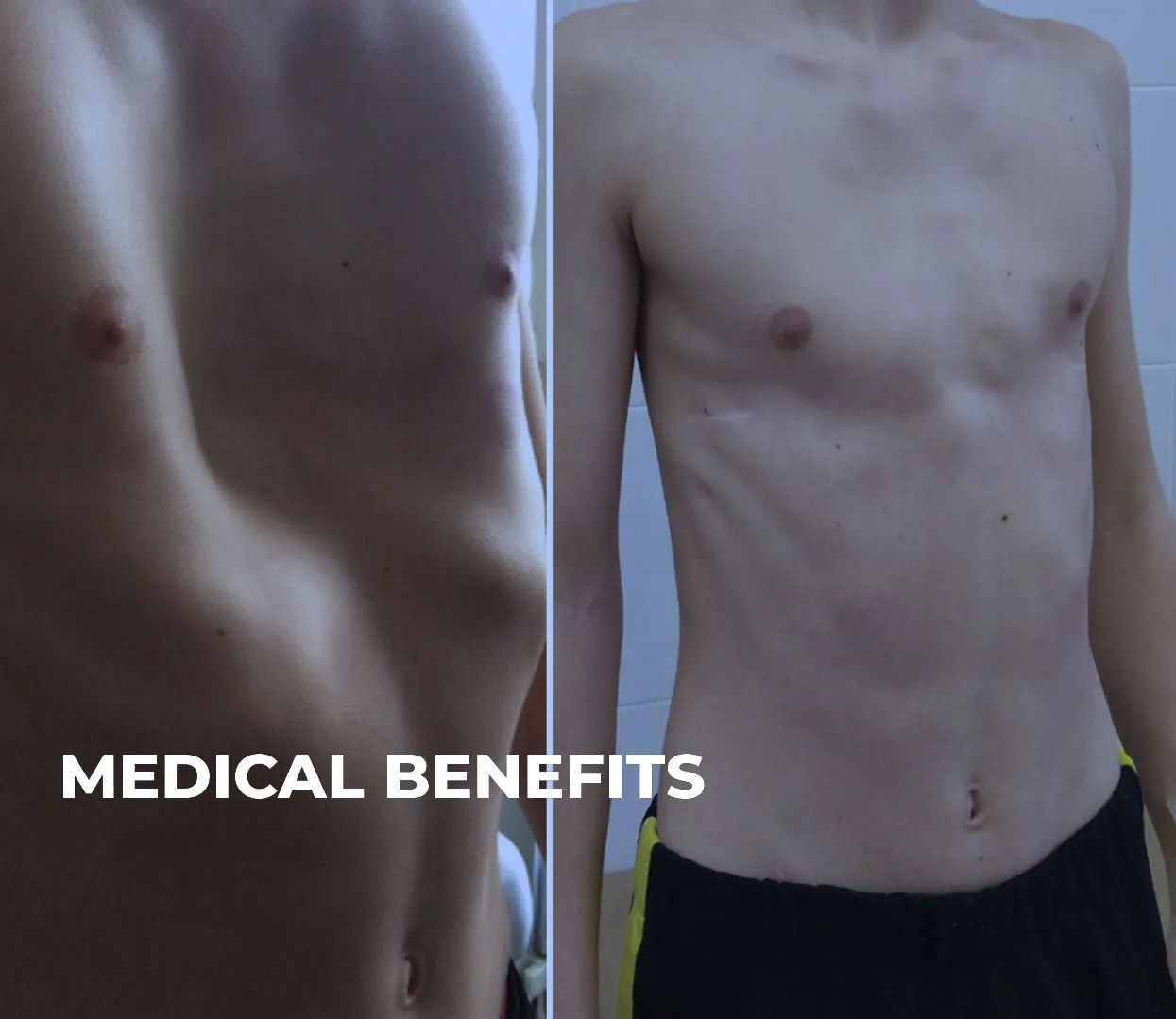 A patient's chest with pectus excavatum before and after the Nuss procedure