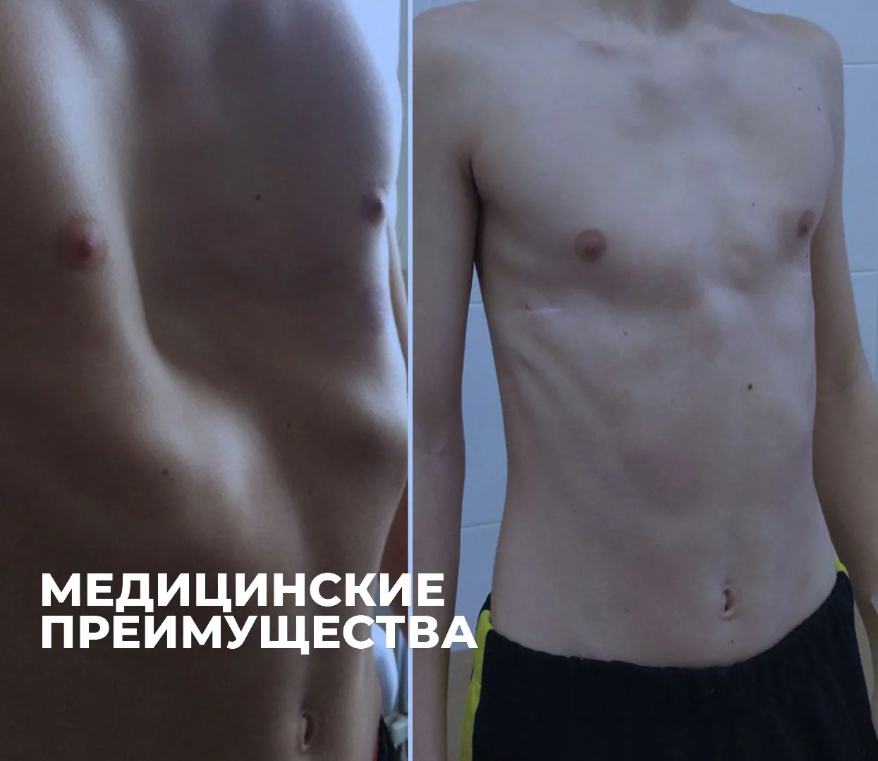 Грудная клетка пациента с воронкообразной деформацией до и после операции по методу Насса