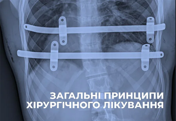 Рентгенограма грудної клітки з двома фіксаторами після корекції за методом Насса