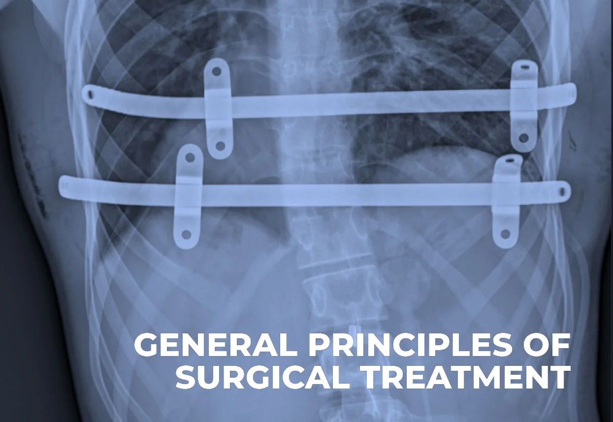 Chest X-ray showing two bars after correction with the Nuss procedure
