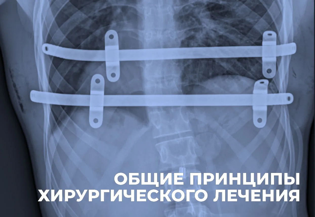 Рентгенограмма грудной клетки с двумя фиксаторами после коррекции по методу Насса