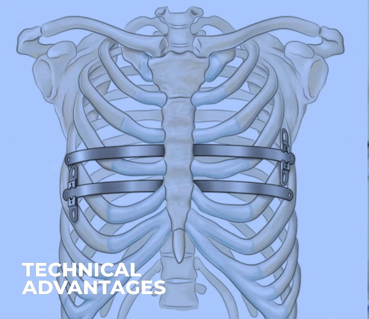 Diagram of a chest with two bars placed using the Nuss procedure