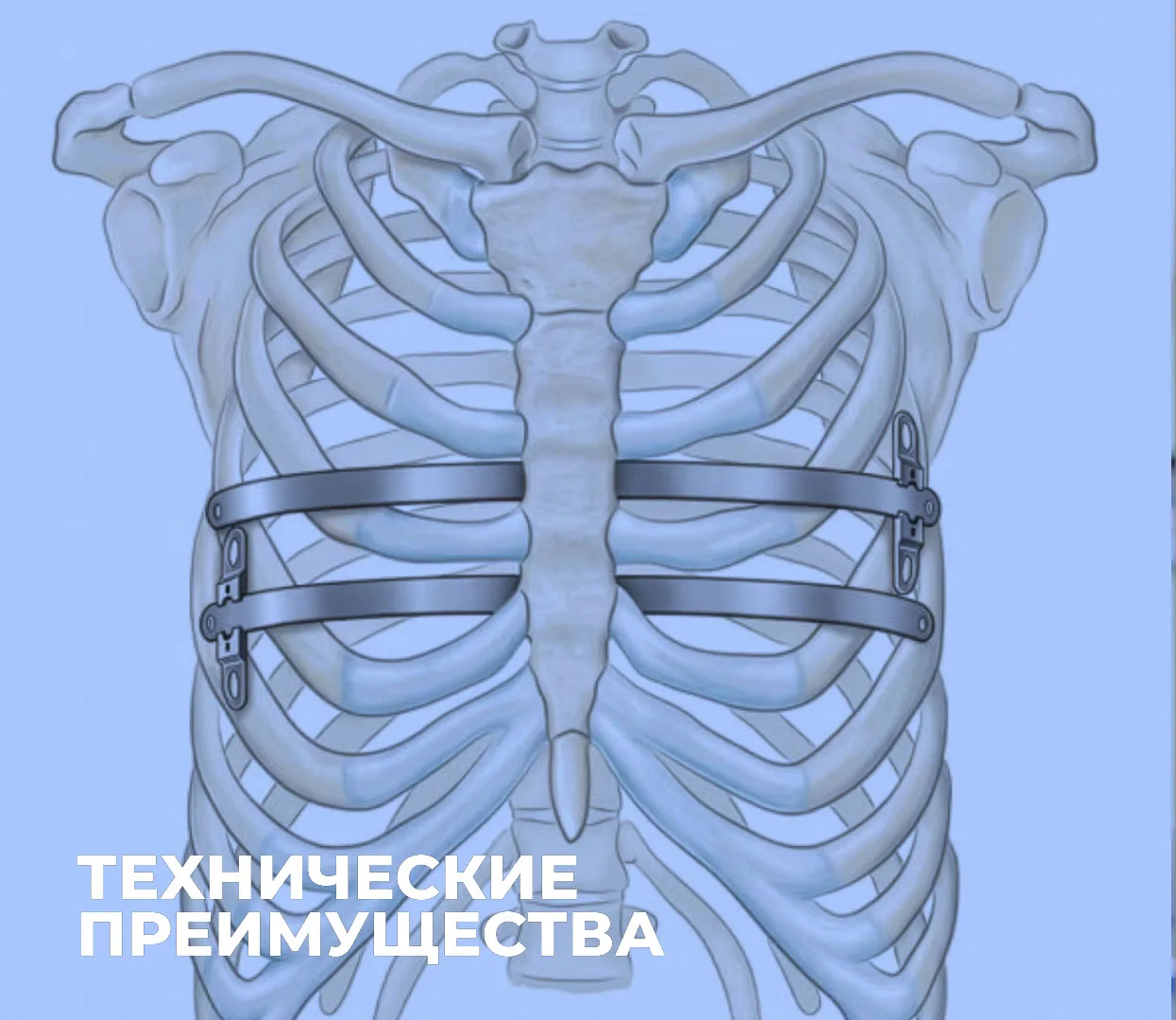 Схема грудной клетки с двумя фиксаторами, установленными по методу Насса